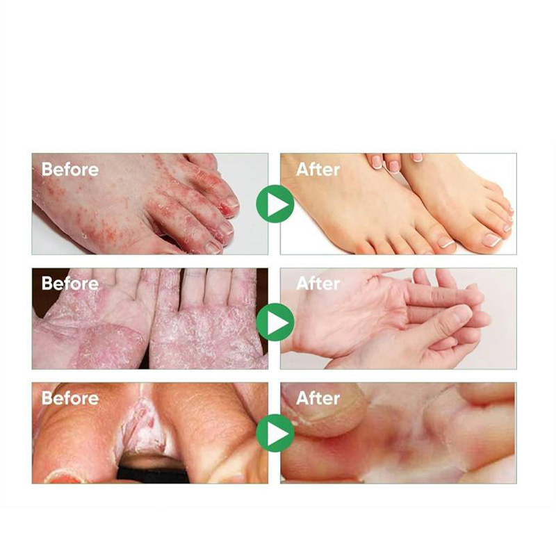 اسپری گیاهی ضدبو و درمان زخم پا حجم 30 میلی لیتر